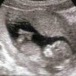 Recomendación de ecografías durante el embarazo